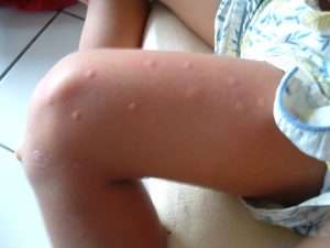 Les moustiques, fléau de l'été