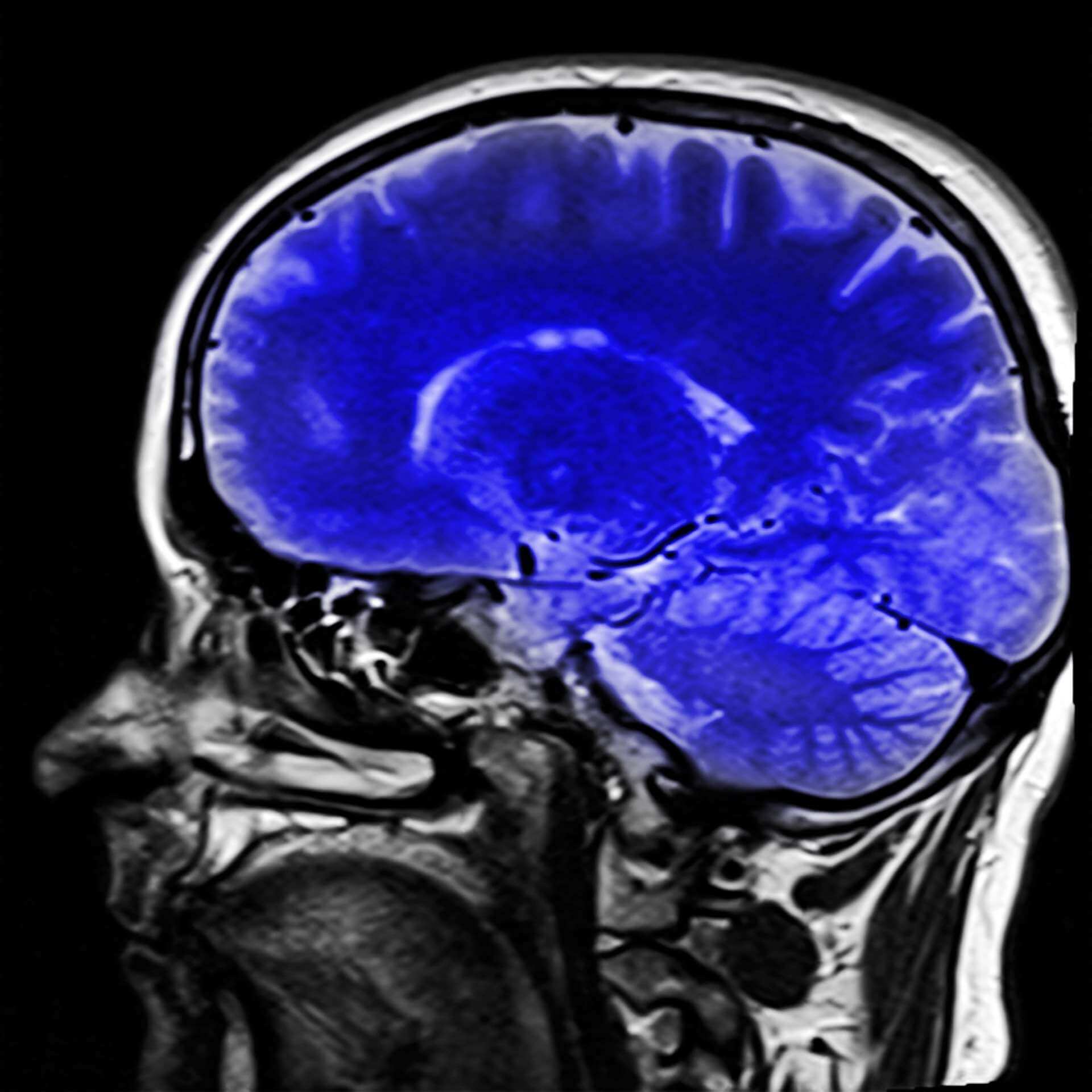 Cliché du cerveau obtenu par IRM. Kai Stachowiak