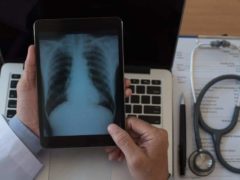 Radio du torse d'un patient reçue sur une tablette numérique. Shutterstock