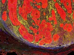 Les cellules cancéreuses (ici en rouge - fausses couleurs) ont une activité électrique qui les distingue des cellules saines. Shutterstock