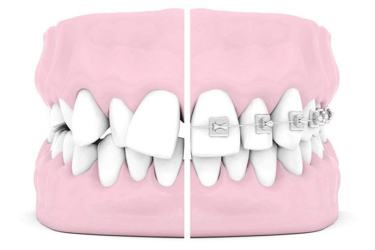 orthodontie-alignement-dents