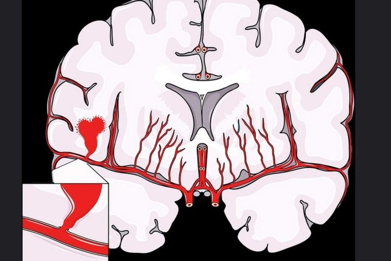 Accident Vasculaire Cérébral hémorragique (Flickr)